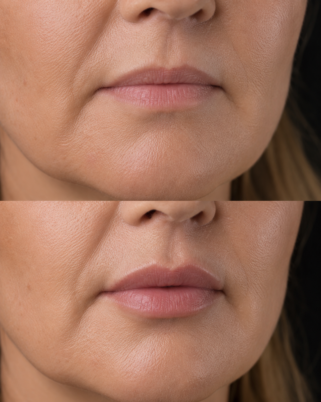 Preenchimento labial feminino